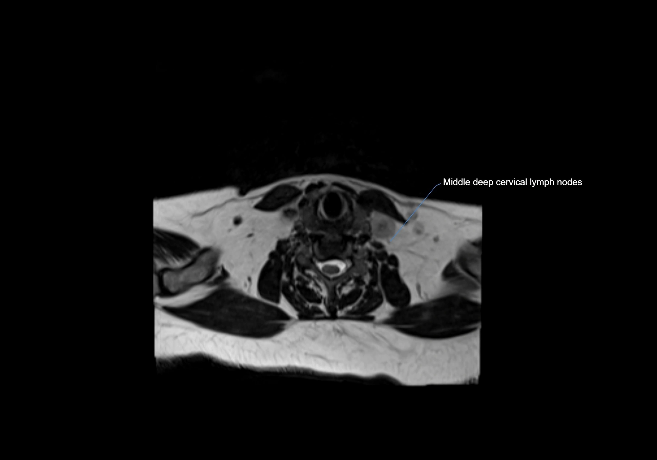 Neck axial  lymph node cross sectional MRI anatomy 3T MRI  image-img-00001-00072.webp